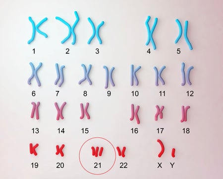 Illustration of Down syndrome karyotype.