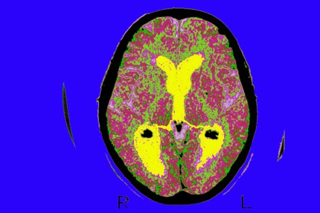 Alzheimer'S Disease, Scan, Brain Of A Patient Affected By Alzheimers Disease, Axial Section, Median Portion Of Dilated Third Ventricle, Symmetrical Dilation Of Intersections, Whereas The Cortical Horns Are Normal In Size.